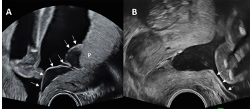 Abb. 1. Kopie aus der Publikation von Schmidt (aus Ref. 3) mit Darstellung der Rupturstelle im Bereiche des unteren Plazen-tarandes.