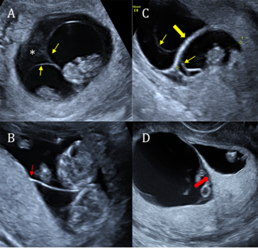 Abb. 2. Diagnose der Chorionizität anhand der Morphologie der Trennwand im ersten Trimenon. A und B monochoriale Zwillinge (gelbe Pfeile: Amnion; rot „T“-sign). C und D dichoriale Situation. Die Amnii (dünne gelbe Pfeile) beider Feten lie-gen dem Chorion (dicker gelber Pfeil) an. Im Teilbild D sieht man das klassische lambda-sign (roter dicker Pfeil).