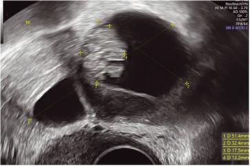 Abb. 3. Suspekter, zystisch solider Adnexbefund bei einer 39-jährigen Patientin. Diagnose nach einseitiger Adnexektomie im Bergebeutel: seröser Borderline Tumor des Ovars.