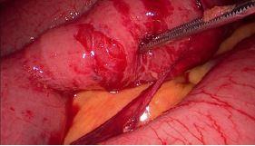 Abb. 2. Kleine Serosaläsion, welche problemlos mit zwei ­Einzelknopfnähten mit monofilem Faden Stärke 4.0 übernäht werden konnte.