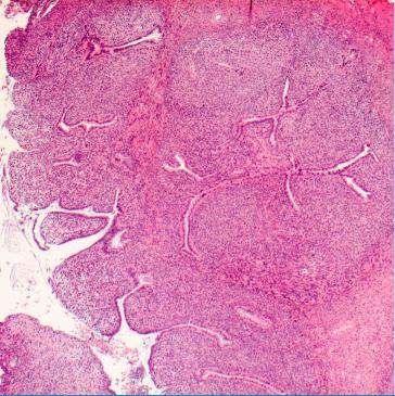 Abb. 3. Histopathologisch typische Morphologie mit teils blattartigen Strukturen an der Oberfläche und manschettenartiger Verdichtung des Stromas.
