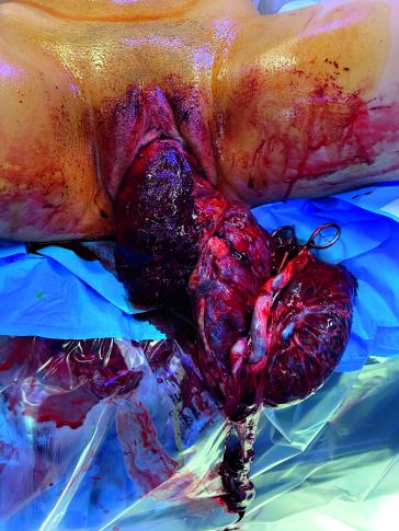 Abb. Intraoperativer Aspekt vor Repositionierung mit adhärenter Plazenta.