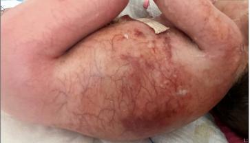 Bild 1. Pränatale Befunde mit (A) weiter intrahepatischer Lebervene bei AV-Shunt aus der Aorta (B, gelber Pfeil); (C) echo-gener Darm und (D) Micro-/Hypognathie (gelbe Pfeile); (E) echogene Gallenblase (gelber Pfeil); (F) glockenförmiger Thorax. Auffällig bei den Thoraxbildern A, C, E ist die sehr echogene Hautbegrenzung wohl als möglicher Hinweis für die restriktive Dermatopathie zu werten. Dies kann auch in der beigelegten Videosequenz (QR-Code) gesehen werden. Auffällig dort auch die schlechte Darstellung des Herzens wegen der Thoraxdeformität mit Engstellung der Interkostalräume!