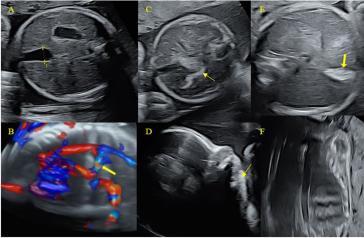 Bild 2. Röntgenbilder (A) Gesichtsskelett mit Micrognathie, weite Suturae; (B) kleiner, gering glockenförmig konfigurierter Thorax, kurze Rippen, dysplastische Claviculae beidseits (gelb umrandet)