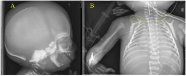 Bild 3. Durchscheinende, dünne Haut mit prominenter dermaler Gefässzeichnung