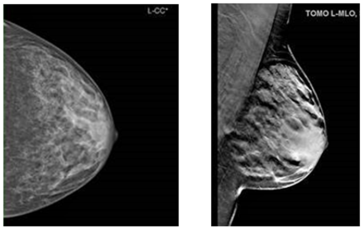 Abb. 2. Mammasonographie links mit Darstellung des Tumors in der 9-Uhr-Achse weit sternal sowie Mammographie in zwei Ebenen links.