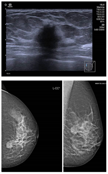 Abb. 3. Sonographie und Mammographie Mamma links