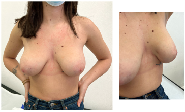 Abb. 7. Präoperativer ­Mammastatus, Schnitt­führung und postoperatives Resultat