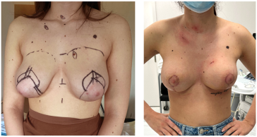 Abb. 7. Präoperativer ­Mammastatus, Schnitt­führung und postoperatives Resultat