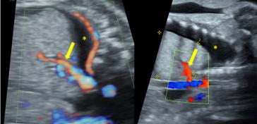 Abb. 2. Zwei Beispiele von Lungensequester, beide bei Feten mit Hydrops (hier Hydrothorax, *). Mit dem Pfeil markiert sieht man den sog. feeding vessel/Gefässstiel welches direkt aus der Aorta entspringt.
