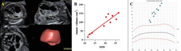 Abb. 3. CPAM-Verhalten während der Schwangerschaft: A) 3D-Bestimmung des Volumens (VOCAL-Technologie); B) Tu-morvolumen während der Schwangerschaft; C) progressives Polihydramnion