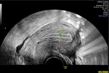 Abb. 2a und b. Trilaminares Endometrium, sprungreifer Follikel