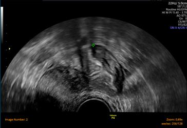 Abb. 1b. Reduzierte ovarielle Reserve, AFC 2