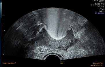 Abb 3. Unauffällige Darstellung der Tuben mittels Kontrastmittelsonographie