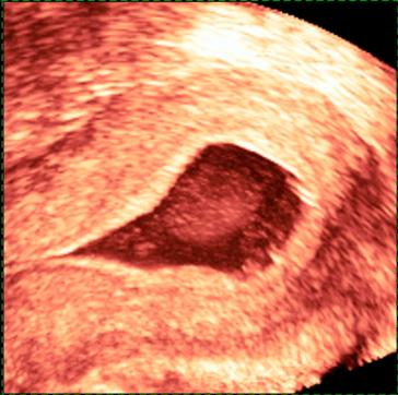 Abb. 4. 3-D-Darstellung des Endometriums und eines Polypen (Bilder dankenswert von Prof. Luigi Raio).Abb. 5 und 6. Ute-rus ­Septus vor und nach Durchtrennung des ­Septums (Prof. L. Raio).