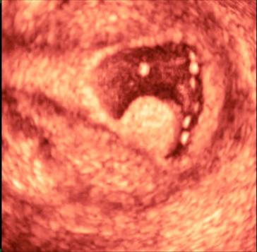 Abb. 4. 3-D-Darstellung des Endometriums und eines Polypen (Bilder dankenswert von Prof. Luigi Raio).Abb. 5 und 6. Ute-rus ­Septus vor und nach Durchtrennung des ­Septums (Prof. L. Raio).
