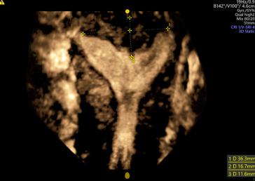 Abb. 5 und 6. Uterus ­Septus vor und nach Durchtrennung des ­Septums (Prof. L. Raio).