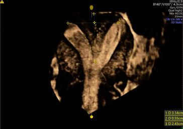 Abb. 5 und 6. Uterus ­Septus vor und nach Durchtrennung des ­Septums (Prof. L. Raio).