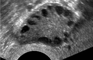 Abb. 1c. AFC erhöht bei PCOS, ACF >15