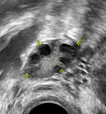 Abb. 1a. Unauffällige ovarielle Reserve, AFC 8