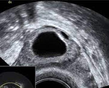 Abb. 2a und b. Trilaminares Endometrium, sprungreifer Follikel
