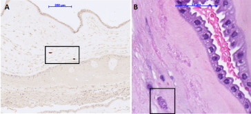 Abb. 4. (A) Immunhistochemie der Plazenta mit Toxoplasmen im Amnionstroma. (B) Plazenta nach Hämatoxy-lin-Eosin-(HE)-­Färbung.