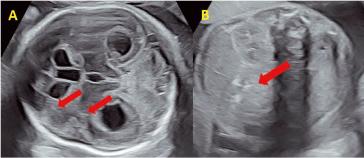 Abb. 1. Befunde in der 27. SSW: (A) Triventrikulärer Hydrocephalus mit periventrikulären Aufhellungen und echogenen Verdichtungen in der Matrix. (B) Auch in der Leber sieht man echogene, gruppierte Verkalkungen und Hinweise für einen Aszites.