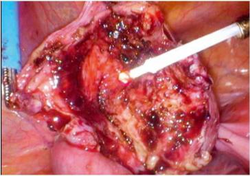 Abb. 1. Geöffnete Endometriosezyste: starke Durchblurung Entzündungszeichen)