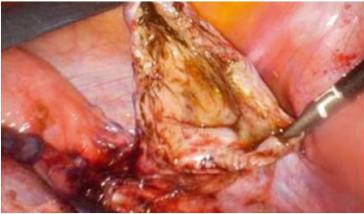 Abb. 2. Konsolidierter, kaum durchbluteter Pseudozystenbalg