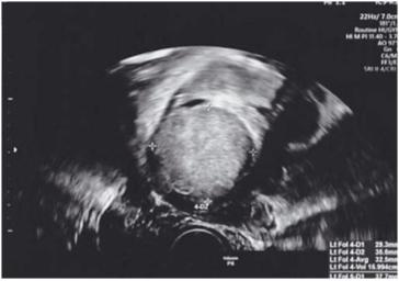 Abb. 3. Präoperatives Ultraschallbild