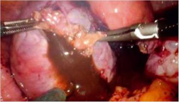 Abb. 4. Eröffnung der Endometriosezyste, entweichender „schokoladenförmiger“ Inhalt