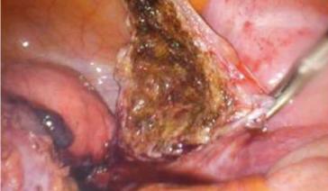 Abb. 5. Nach CO-2 Laserevaporisatio (blutungsfrei)