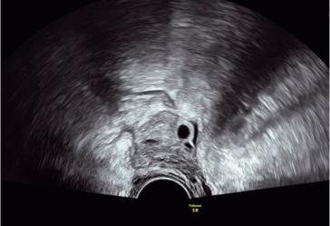 Abb. 6. Postoperatives Ultraschallbild