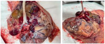 Abb. 2. Makroskopie der Plazenta mit disseminierten Amnionzysten, welche etwa die Hälfte der Oberfläche einnehmen, und die andere Plazentahälfte weisslich als Hinweise für Ischiämie. Die Nabelschnur inseriert zentral.