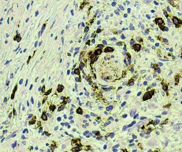 Abb. 6. Immunfärbung auf CD 138 (Endometritis). Prof. G. Singer, Institut für Pathologie, Kantonsspital Baden.