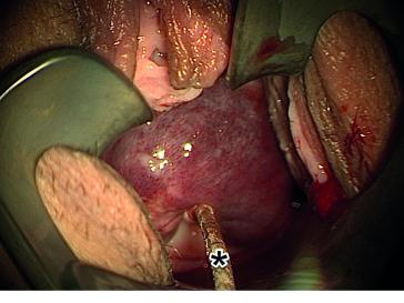 Abb. 1. Cervix uteri mit grossem, die gesamte Zirkumferenz einnehmendem kavernösem Hämangiom. Ein Wattestäbchen wurde in die Zervix eingeführt (✱).