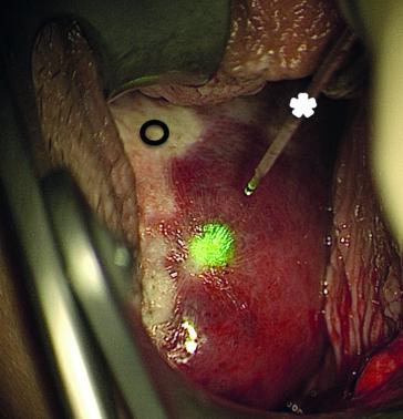 Abb. 2. Ablation bzw. Koagulation des kavernösen Hämangioms mit dem Nd:YAG Laser (✱). Der schon behandelte Bereich kann deutlich erkannt werden (O).