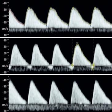 Abb. 1. Variable Dopplerflussmuster, je nachdem welche Arterie untersucht wurde.