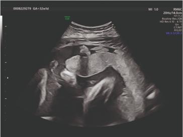 Zuweisung wegen leichten, portiowirksamen Kontraktionen in der beginnenden 33. Schwangerschaftswoche. Klinisch weicher Bauch und normales CTG. Die Frau wurde kurz nach dem Eintrittsultraschall sektioniert. Wieso?