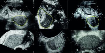 Abb. 1a. Drei Fälle von Schwangerschaften bei schwerer Endometriose; obere Reihe in Relation zur Zervix und untere Reihe sind die einzelnen Tumoren herausprojiziert. Die Endometriome (Gelb umkreist) liegen allesamt im Douglas und zeigen die typische,  homogene Binnenstruktur auf. Das mittlere Ovar weist neben dem Endometriom noch ein echohelleres Corpus luteum (CL) auf.