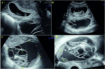 Abb. 2a. Schwangerschaft in der 10. Woche. Retrozervikal im Douglas zystischer Tumor mit „unruhigen“ Binnenstrukturen und nicht ganz echoleerem, flüssigem Inhalt. Grösse  knapp 9 cm. (A, B, D) transabdominale Bilder; (D) transvaginales Bild, welches neben den zystischen Anteilen auch echodichtere randständige Auflagerungen zeigt (*).