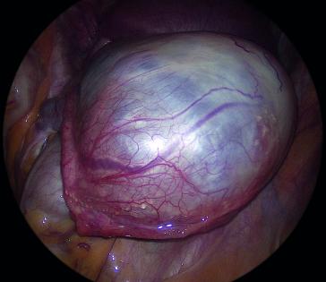 Abb. 2b. Intraoperatives Bild vom gleichen Tumor. Es erfolgte eine Adnexektomie links in der 16. SSW, die definitive Histologie ergab einen muzinösen Borderline-Tumor min. pT1a pN(0/1 Omentum) L0 V0 Pn0 GB Rx; FIGO-Stadium: IC1.