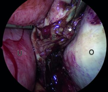 Abb. 1b. Intraoperatives Bild eines Endometrioms in der 16. SSW mit den typischen papillären Strukturen, welche dezidualisierter Endometriose entsprechen (*). U = Uterus, E = Endometriom, O = Restovar