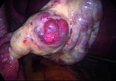 Adnextumoren in der Schwangerschaft