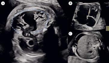 Abbildung 1. (A) weite, rechte Pulmonalarterie (PA), welche den vaskulären Tumor (blau umrandet) versorgt; (B) grosses Herz; (C) Aszites im Rahmen des Hydrops fetalis infolge Hyperzirkulation 