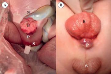 Abbildung 1. (A) direkt postnatales und (B) intraoperativer Situs. N = Nabel mit Nabelschnur; B = Blasenexporphie; P = kleiner Penis mit E = Epispadie; S = Scrotum