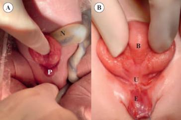 Abbildung 2. (A) direkt postnatales und (B) intraoperativer Situs. N = Nabel mit Nabelschnur; B = Blasenextrophie; P = kleiner Penis mit E = Epispadie; U= Urethra
