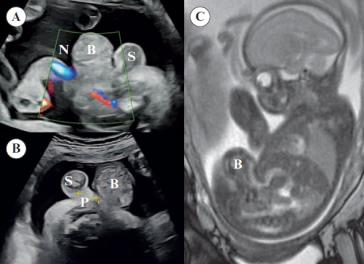 Abbildung 3. (A) Höhe Nabel (N) sieht man kaudal (im Bild rechts) des Nabels die Omphalocele bzw. Blasenextrophie (B) und dann ein Scrotum (S); (B) zwischen Omphalocele und Scrotum erscheint ein kleiner Penis (P); (C) fetales MRI, welches eigentlich nicht mehr Informationen geliefert hat.
