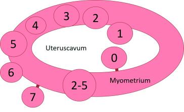Abbildung 1: Myomklassifikation nach FIGO