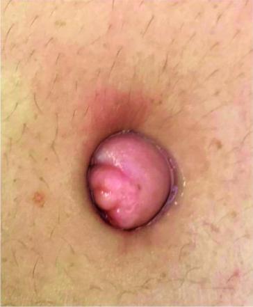 Klinische Bilder von umbilikaler Endometriose (Quelle: Chakraborty, Slide Share)